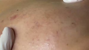 Лечение прыщей у подростка в салоне — полный процесс