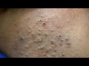 Агрессивное удаление глубоких черных точек | Уход за кожей для чистоты