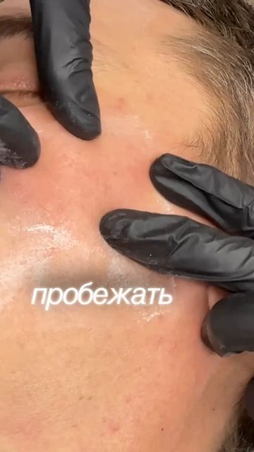 Удаление комедонов после салицилового пилинга смотреть онлайн