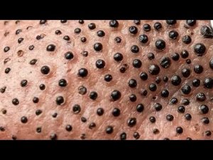 Удаление черных головок — новое шоу