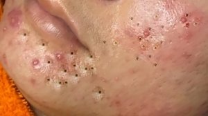 Экстремальное удаление черных точек 🧖♀️ Удовлетворение и релакс