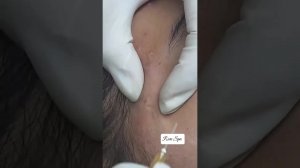 Люблю выдавливать прыщи