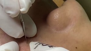 Удаление открытых и закрытых комедонов — полный процесс экстракции