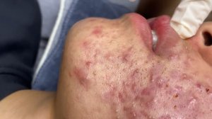 254 • Acne collection • АСМР • Relax Spa