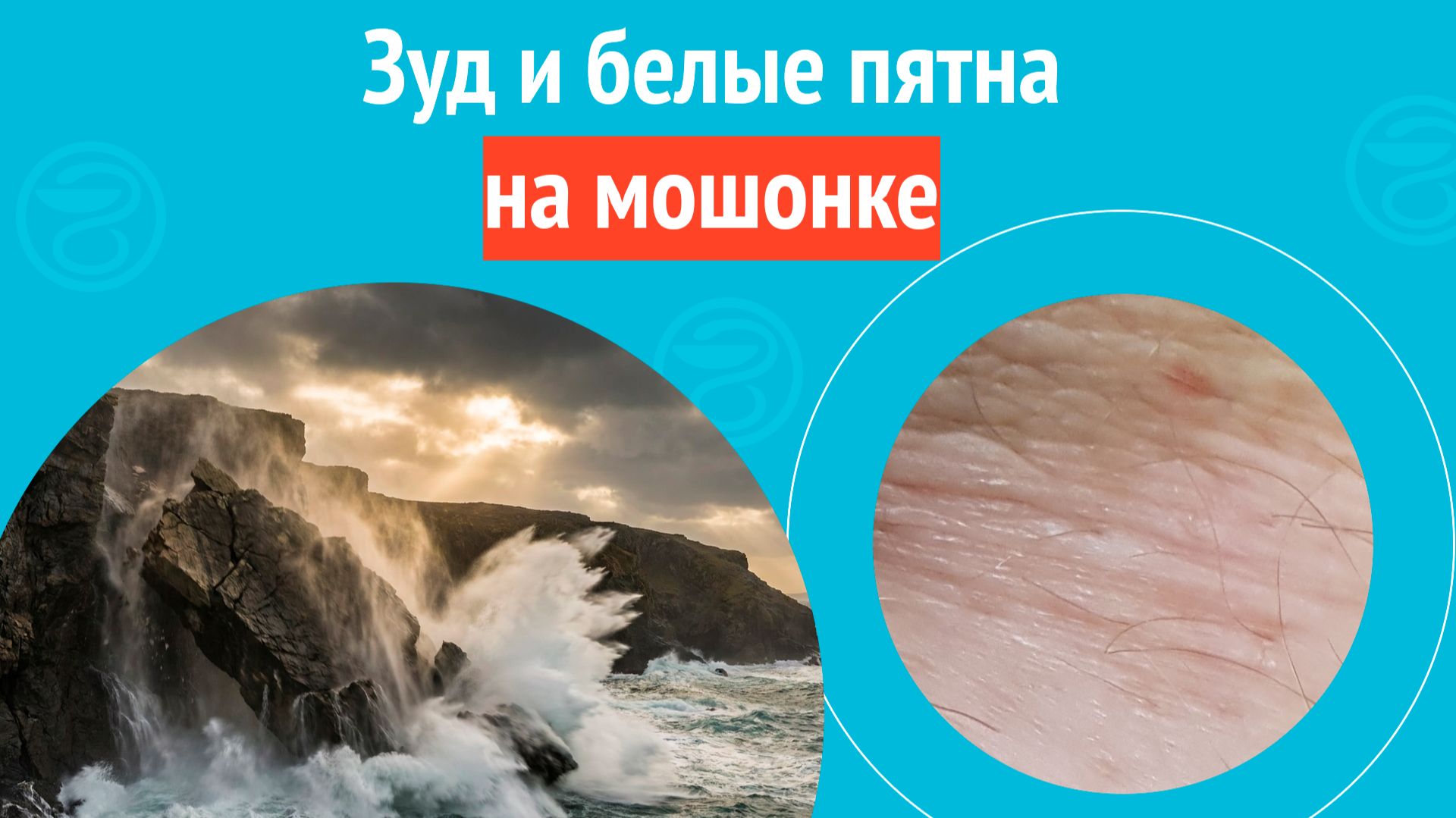 😧 Зуд и белые пятна на мошонке. Клинический случай №1675 смотреть онлайн