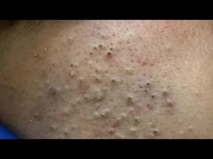 Глубокое очищение пор от акне | Удовлетворяющее удаление черных точек!