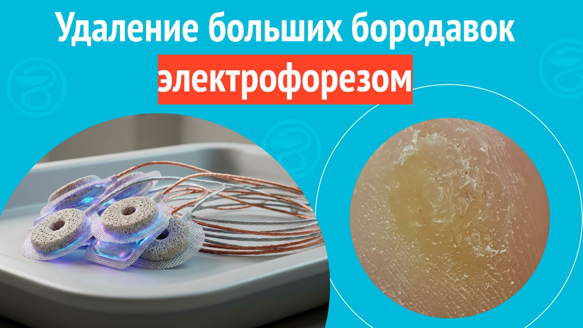 🦶 Удаление больших бородавок электрофорезом. Клинический случай №1676 смотреть онлайн