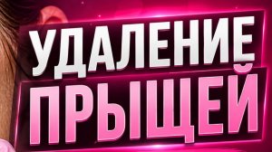 Удаление прыщей часть #3. Отличное качество!