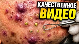 Выдавливание прыщей. Хорошее качество для подписчиков #791