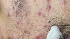 284 • Acne collection • АСМР • Relax Spa
