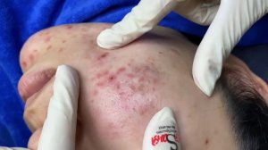 277 • Acne collection • АСМР • Relax Spa
