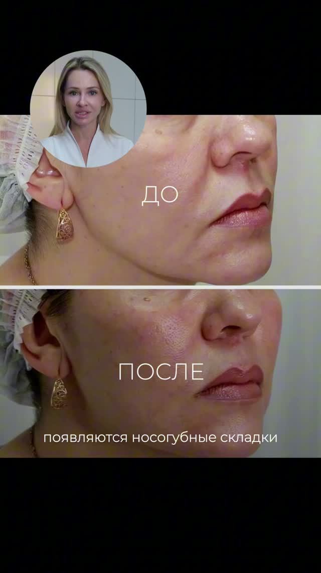 Зачем увеличивают скулы филлером?