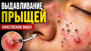 Выдавливание прыщей. Лучшее качество для подписчиков