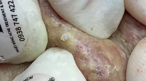 Удаление черных точек и подкожных прыщей