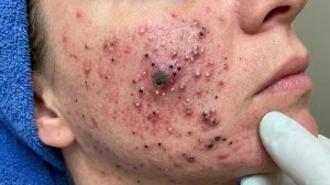 Удаление черных точек в Sac Dep Spa @451