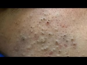 Глубокое удаление черных точек | Корейский уход за кожей при акне