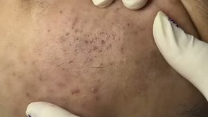 Удаление акне и закрытых комедонов на щеке