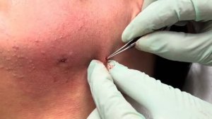 ВЫДАВЛИВАЕТ ПРЫЩИ И УГРИ. СОЧНОЕ РЕЛАКС ВИДЕО