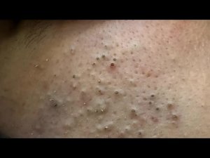 Контроль себума и удаление черных точек | Корейский уход