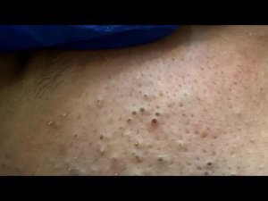 Уход за кожей | Корейская рутина от черных точек и прыщей