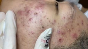 283 • Acne collection • АСМР • Relax Spa