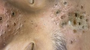Extreme Blackhead Removal Satisfying Relaxing #1002