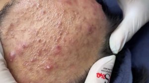 285 • Acne collection • АСМР • Relax Spa