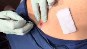 ВЫДАВЛИВАЕТ ПРЫЩИ И УГРИ. СОЧНОЕ РЕЛАКС ВИДЕО