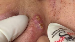 279 • Acne collection • АСМР • Relax Spa