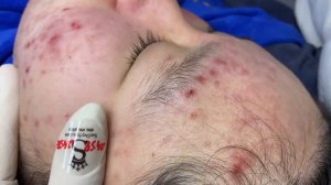 278 • Acne collection • АСМР • Relax Spa