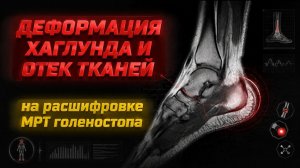 ДЕФОРМАЦИЯ Хаглунда, ОТЕК мягких тканей, АРТРОЗ голеностопа на расшифровке МРТ голеностопного сустав
