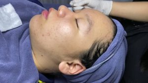 Удаление прыщей и комедонов на щеках — ручная экстракция