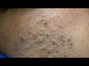 Глубокое удаление черных точек | Корейский уход за кожей при акне