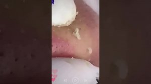 Удаление черных точек пинцетом. Уход за кожей