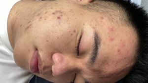 Ручная экстракция комедонов у косметолога