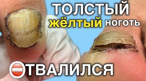 онихогрифозный ноготь ‘встретился’ с диваном 😬 финал ролика вас удивил?