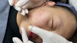 Механическая чистка лица от прыщей и черных точек