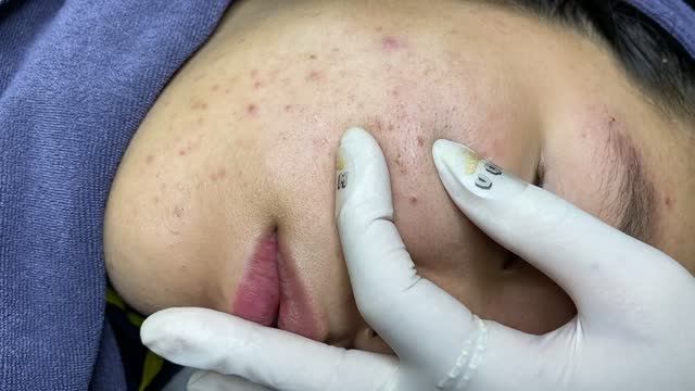 Ручное удаление прыщей на лице смотреть онлайн