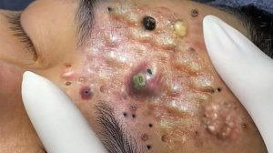 Экстремальное удаление черных точек | Удовлетворение и релаксация