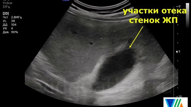 Острый холецистит и застой желчи. смотреть онлайн