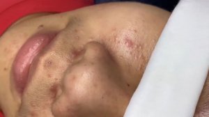 280 • Acne collection • АСМР • Relax Spa