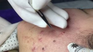 Удаление комедонов на щеках механическим способом