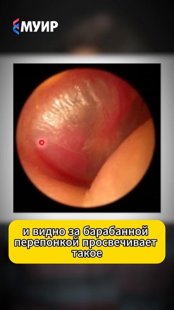 Почему ухо шумит в такт пульсу? Вся правда о параганглиоме #медицина #отоневролог #тиннитус #врач смотреть онлайн