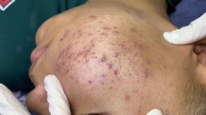 292 • Acne collection • АСМР • Relax Spa