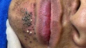 Удаление черных точек в Sac Dep Spa