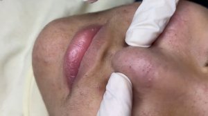 295 • Acne collection • АСМР • Relax Spa