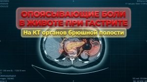БОЛИ в животе и ОТЕКИ по всему телу при ПЕРЕГИБЕ желчного пузыря на РАСШИФРОВКЕ КТ брюшной полости