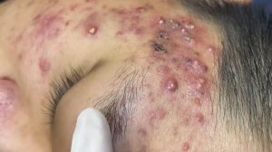 281 • Acne collection • АСМР • Relax Spa