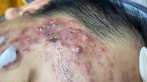 282 • Acne collection • АСМР • Relax Spa