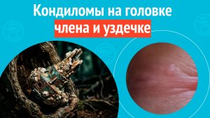 🥺 Кондиломы на головке члена и уздечке. Клинический случай №1670